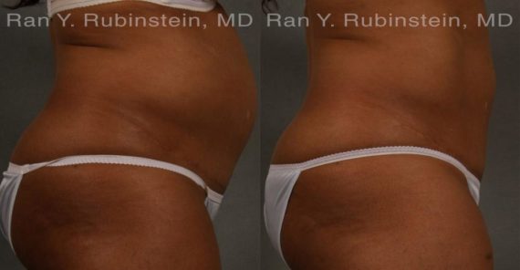 Coolsculpting before and after pictures in Newburgh, NY, Patient 103