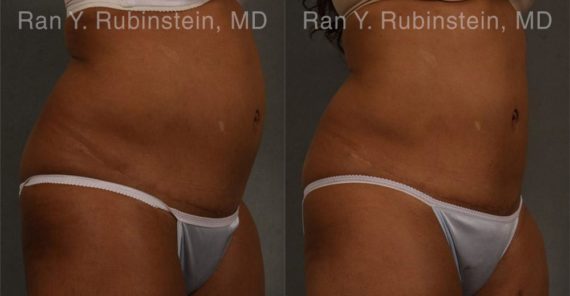 Coolsculpting before and after pictures in Newburgh, NY, Patient 103