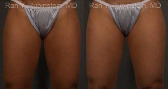 Coolsculpting before and after pictures in Newburgh, NY, Patient 110