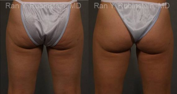 Coolsculpting before and after pictures in Newburgh, NY, Patient 110