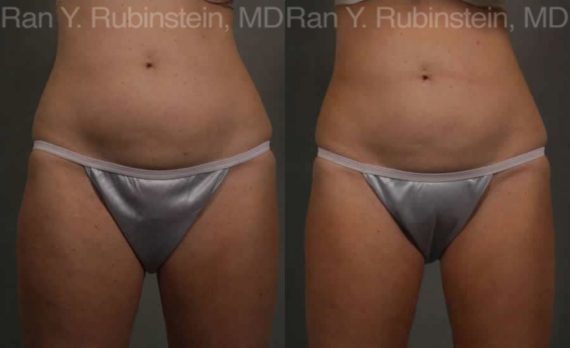 Coolsculpting before and after pictures in Newburgh, NY, Patient 117