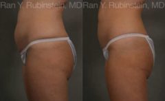 Coolsculpting before and after pictures in Newburgh, NY, Patient 117