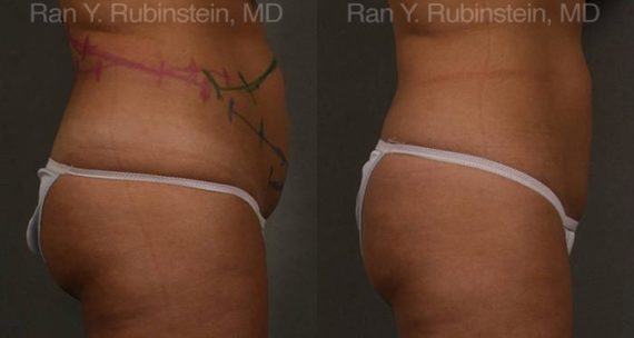 Coolsculpting before and after pictures in Newburgh, NY, Patient 124