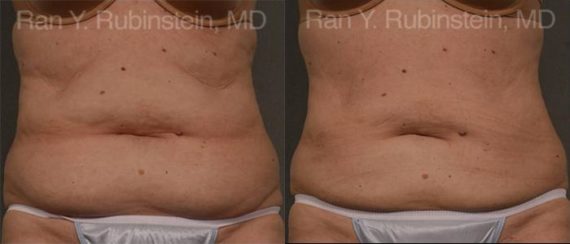 Coolsculpting before and after pictures in Newburgh, NY, Patient 128