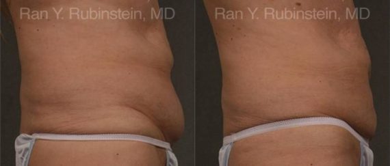 Coolsculpting before and after pictures in Newburgh, NY, Patient 128