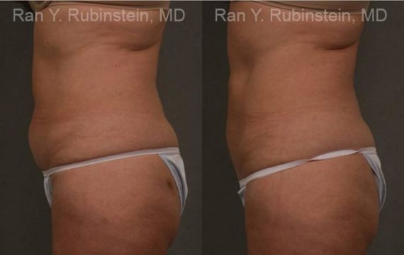 Coolsculpting before and after pictures in Newburgh, NY, Patient 135