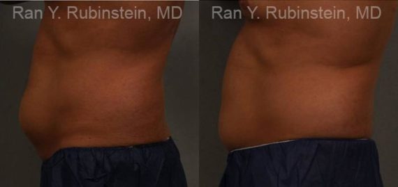 Coolsculpting before and after pictures in Newburgh, NY, Patient 139