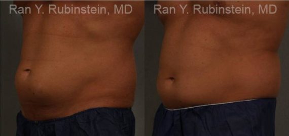 Coolsculpting before and after pictures in Newburgh, NY, Patient 139