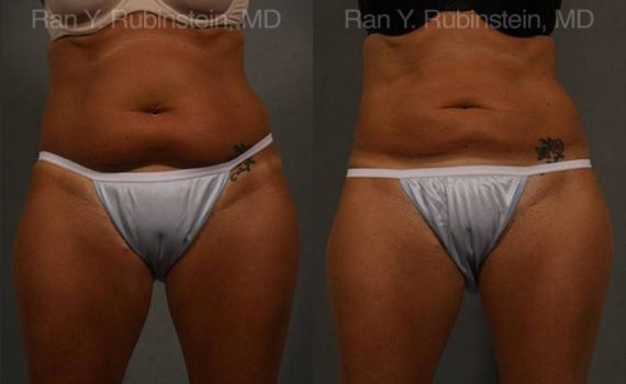 Coolsculpting before and after pictures in Newburgh, NY, Patient 146