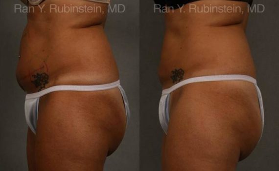 Coolsculpting before and after pictures in Newburgh, NY, Patient 146