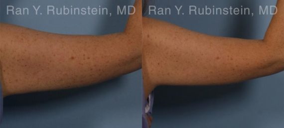 Coolsculpting before and after pictures in Newburgh, NY, Patient 153