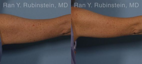 Coolsculpting before and after pictures in Newburgh, NY, Patient 153