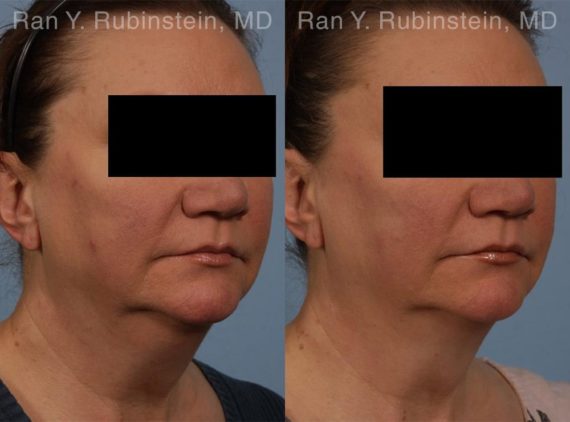 Coolsculpting before and after pictures in Newburgh, NY, Patient 160