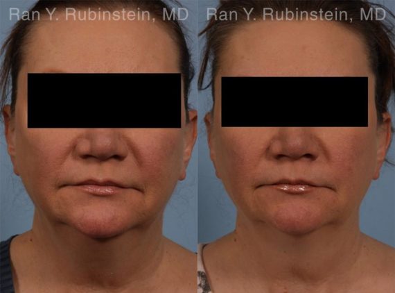 Coolsculpting before and after pictures in Newburgh, NY, Patient 160