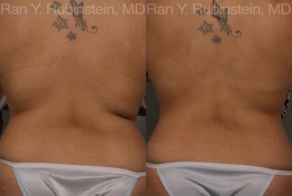 Coolsculpting before and after pictures in Newburgh, NY, Patient 47