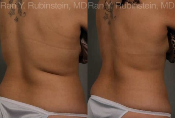 Coolsculpting before and after pictures in Newburgh, NY, Patient 47