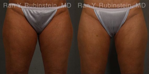 Coolsculpting before and after pictures in Newburgh, NY, Patient 57