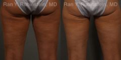 Coolsculpting before and after pictures in Newburgh, NY, Patient 57