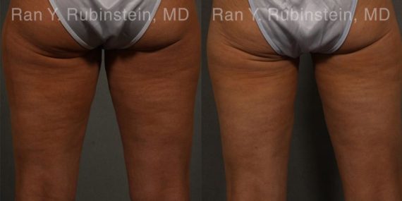 Coolsculpting before and after photos in Newburgh, NY