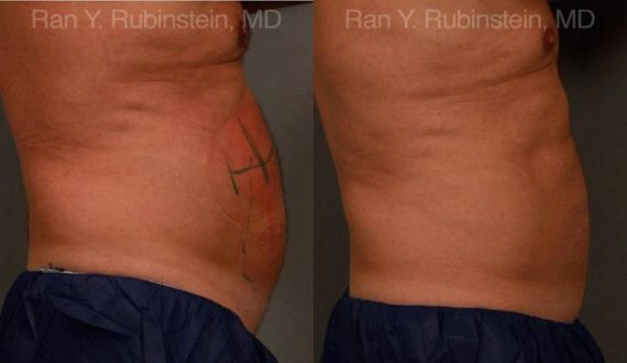 Coolsculpting before and after pictures in Newburgh, NY, Patient 75