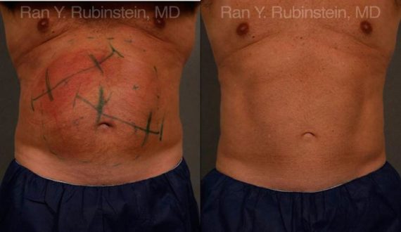 Coolsculpting before and after pictures in Newburgh, NY, Patient 75