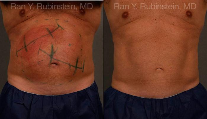 CoolSculpting Before and After 75