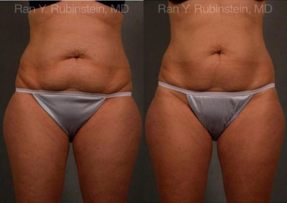 Coolsculpting before and after pictures in Newburgh, NY, Patient 82