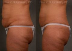 Coolsculpting before and after pictures in Newburgh, NY, Patient 82