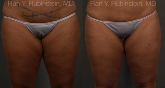 Coolsculpting before and after pictures in Newburgh, NY, Patient 89