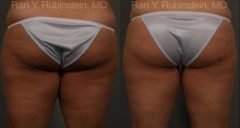 Coolsculpting before and after pictures in Newburgh, NY, Patient 89