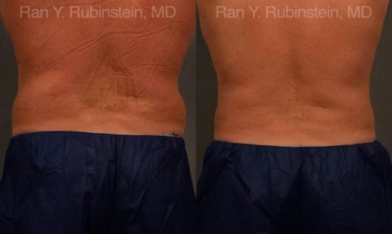 Coolsculpting before and after pictures in Newburgh, NY, Patient 96