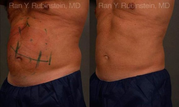 Coolsculpting before and after pictures in Newburgh, NY, Patient 96