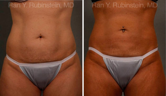 CoolSculpting Before and After Pictures - Female Stomach