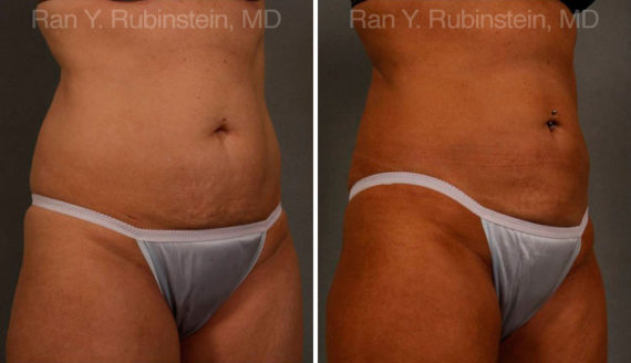 Coolsculpting before and after pictures in Newburgh, NY, Patient 65